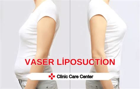 vaser liposuction fiyatları 